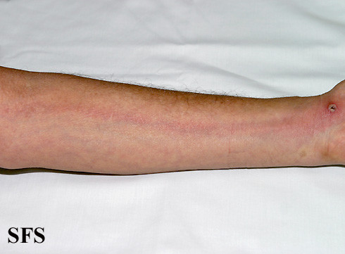 red streaks on legs - pictures, photos