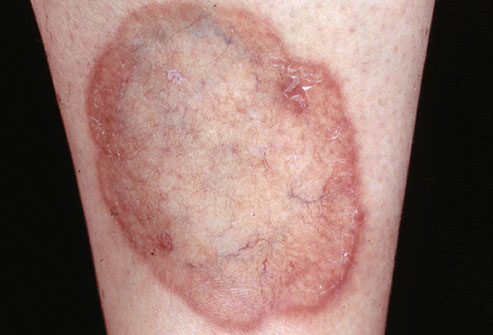 diabetic skin disorder - pictures, photos