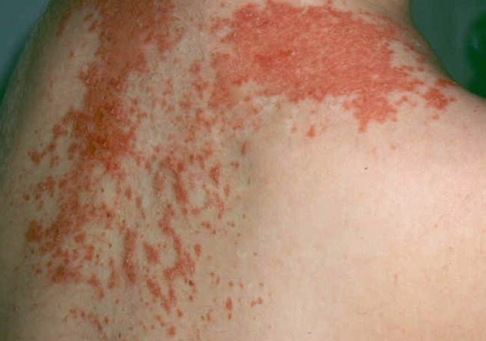 rashes diagnosis - pictures, photos