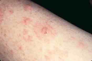 allopurinol rash - pictures, photos