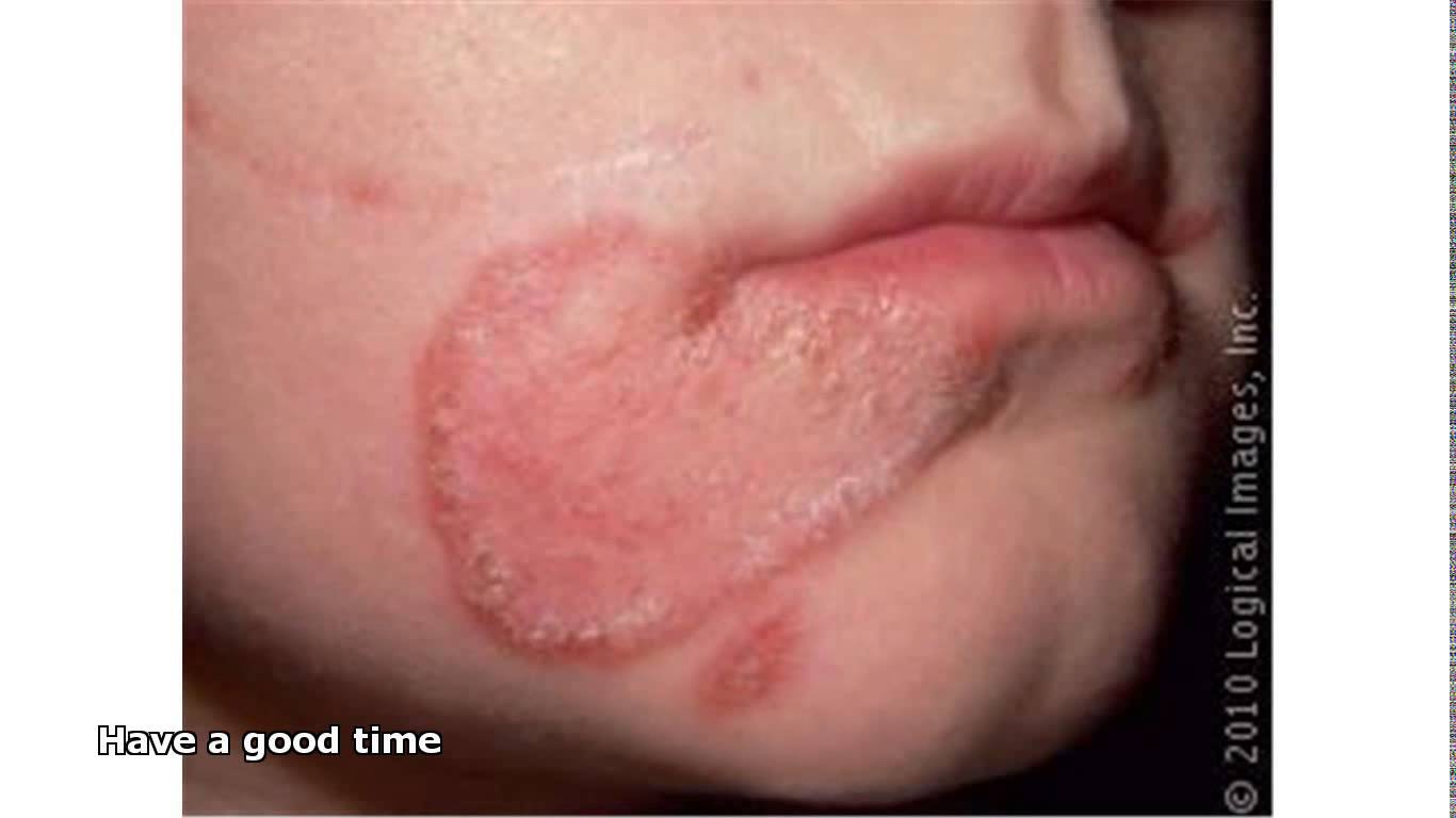 Bacterial Infection Causing Pimples On Face