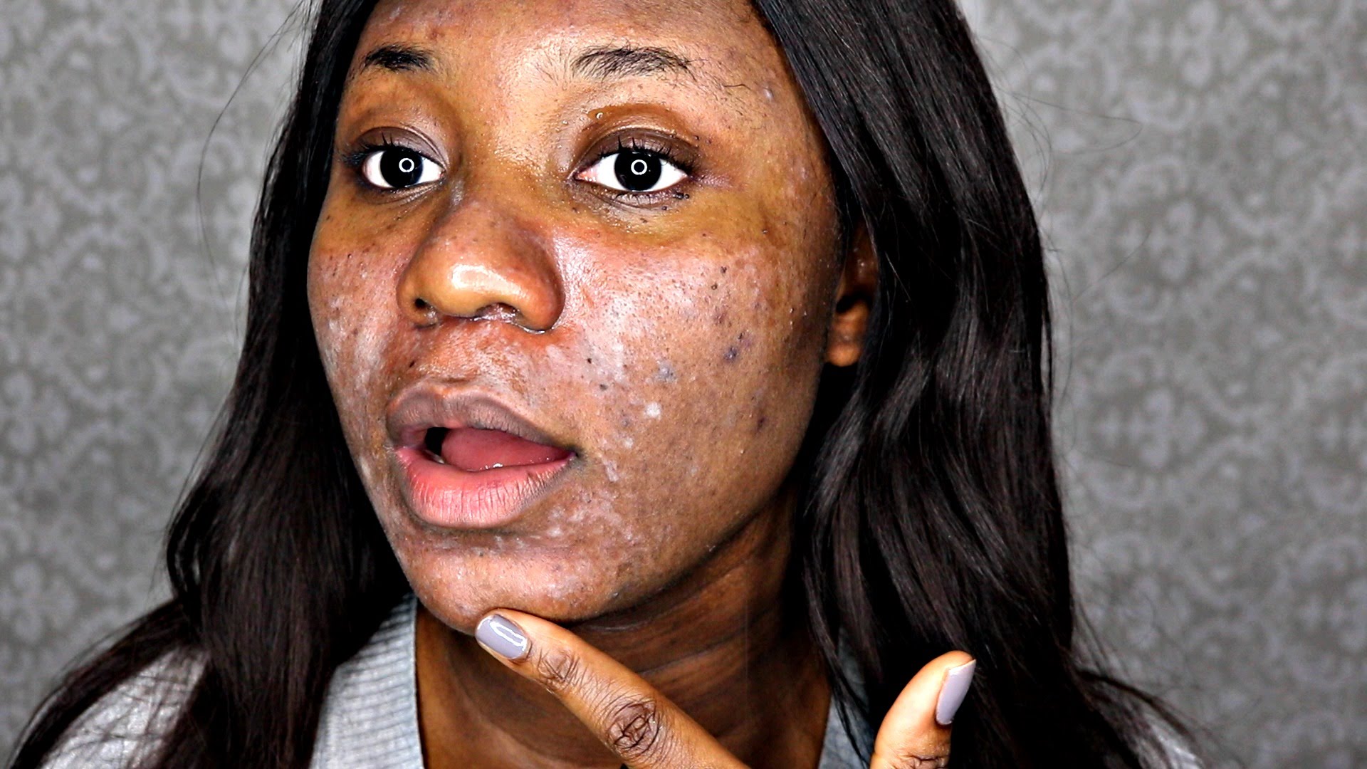 salicylic-acid-acne-pictures-photos