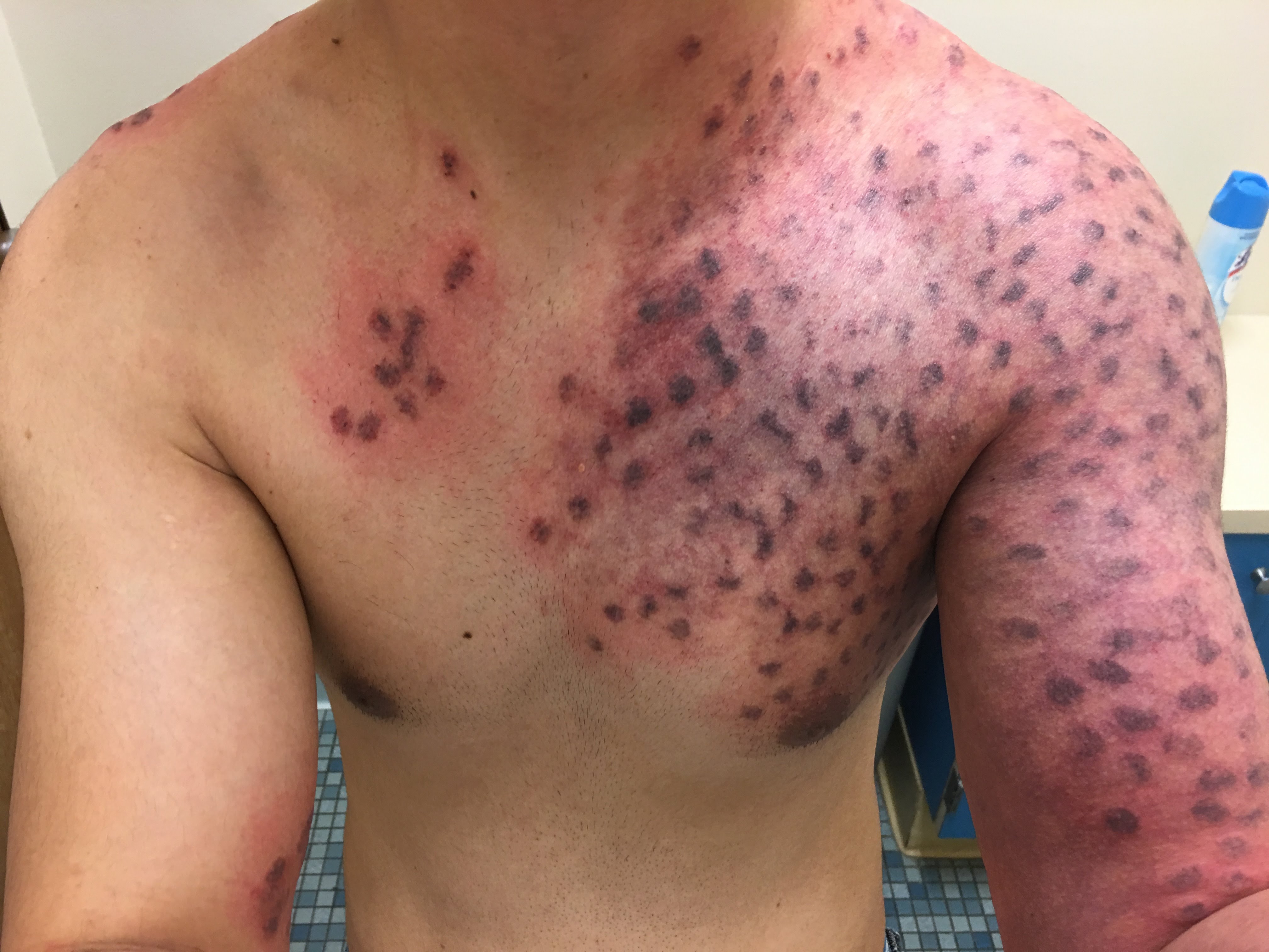 port wine stain port wine stain