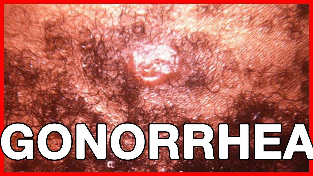 gonorrhea symptoms men