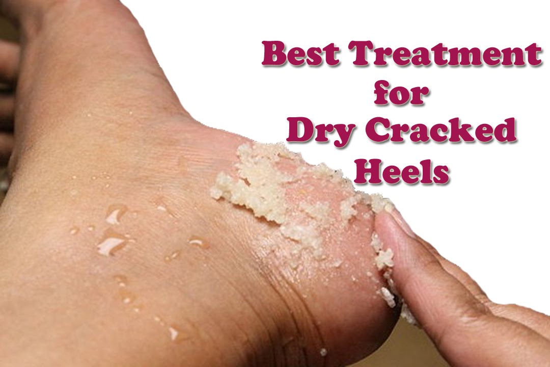 what-causes-cracked-feet-pictures-photos