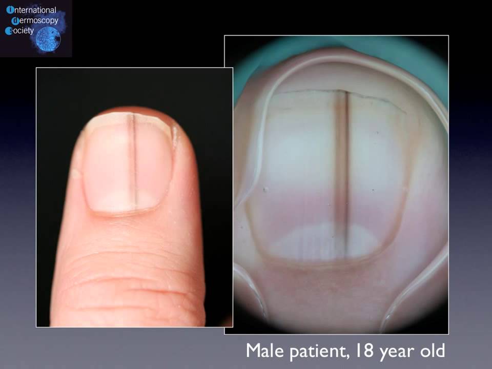 Fico! 29+ Fatti su Vertical Melanoma Faint Black Line On Nail ...