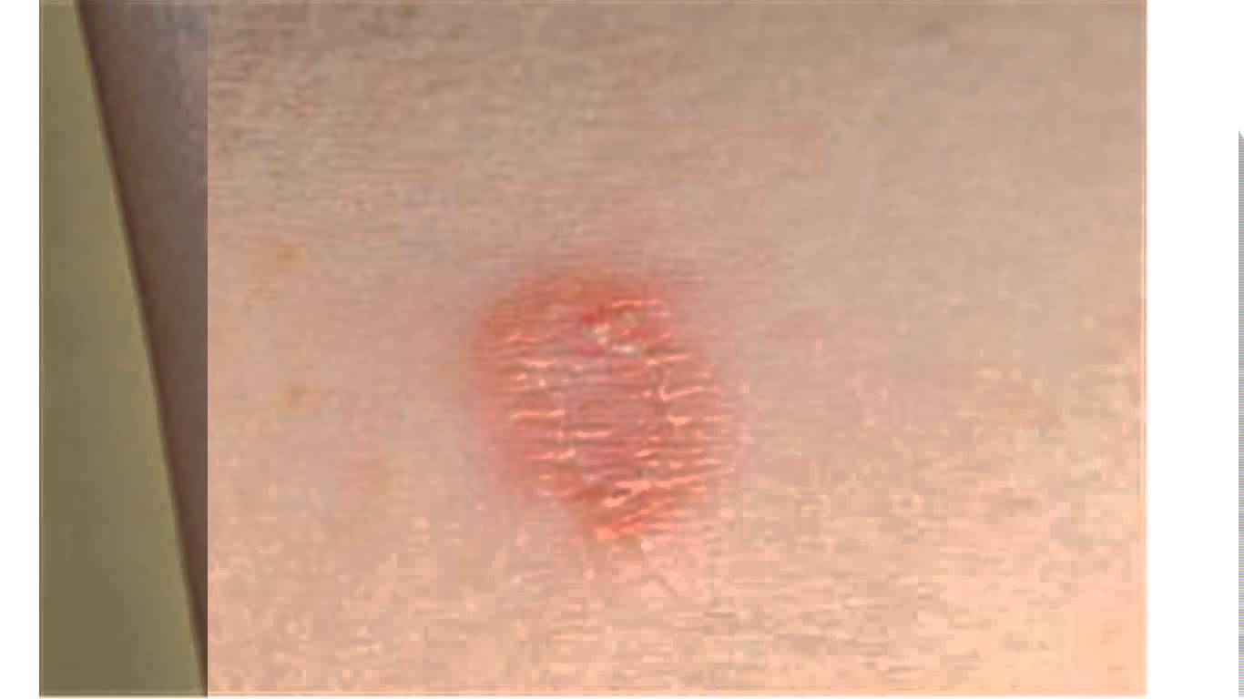 Fungal Spot On Skin