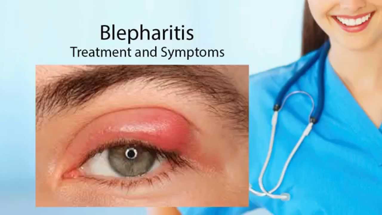 Blepharitis Picture - Pictures, Photos