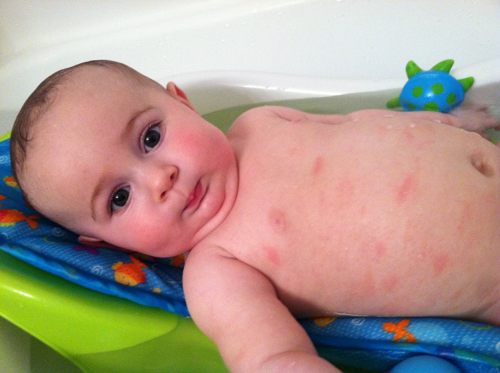 Red Bumps On Baby Body 8 Months