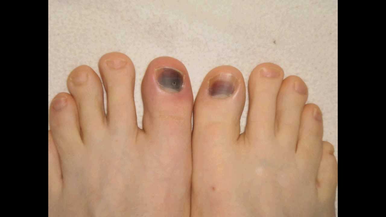 risks-of-diabetic-black-toenail-discoloration-black-toenail-fungus