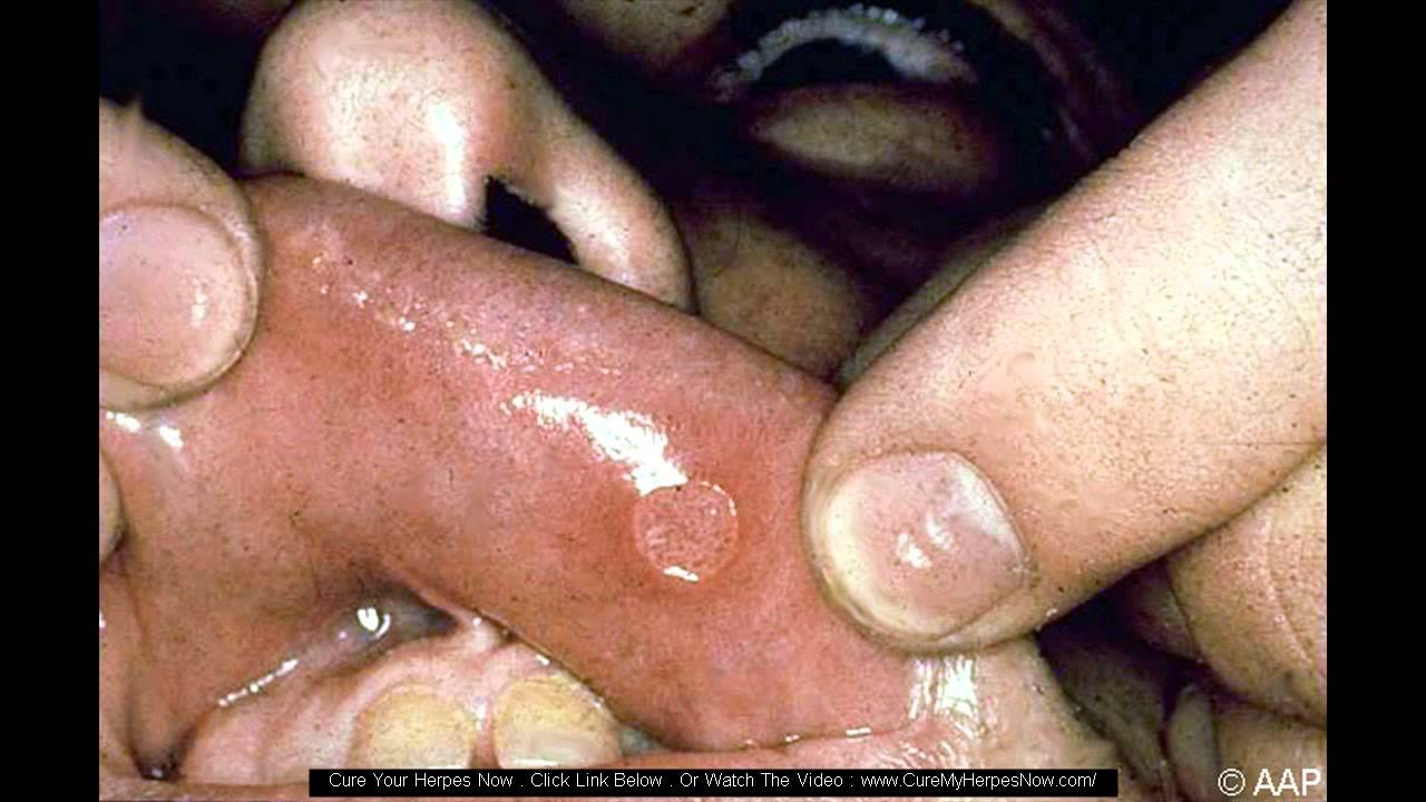 herpes on penis shaft - pictures, photos.