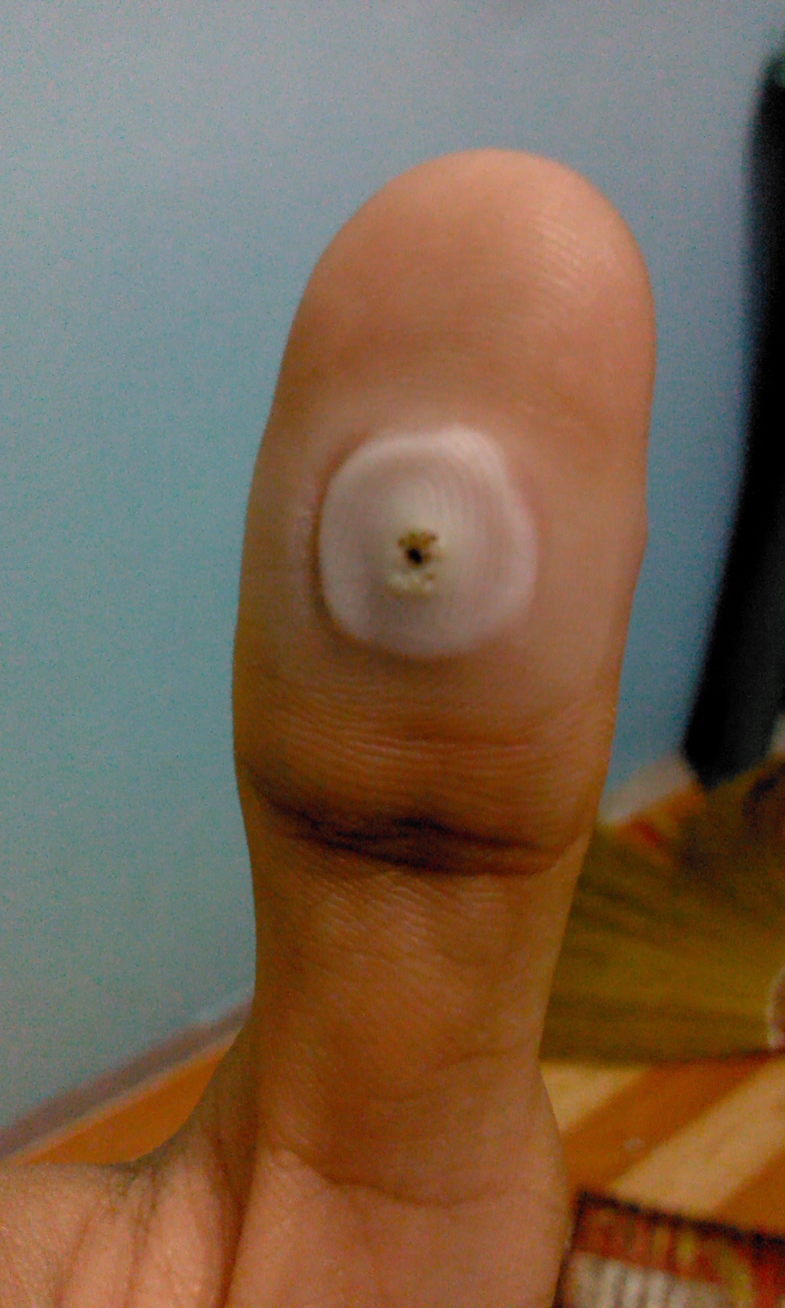 Salicylic acid warts pictures photos