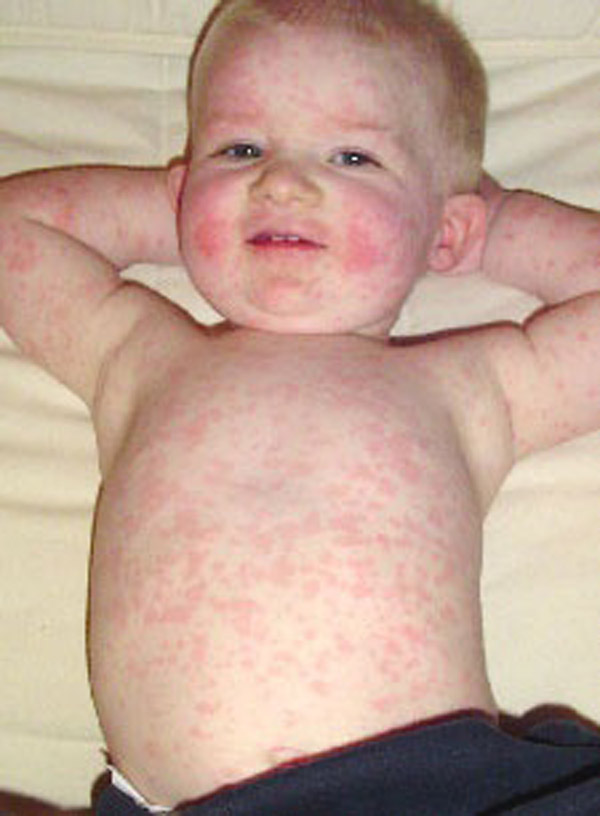 allergy-trigger-red-rash-around-mouth-baby-after-eating