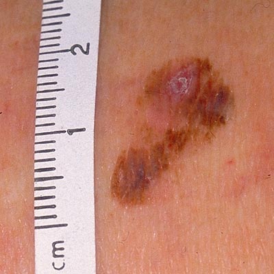 melanoma pic - pictures, photos