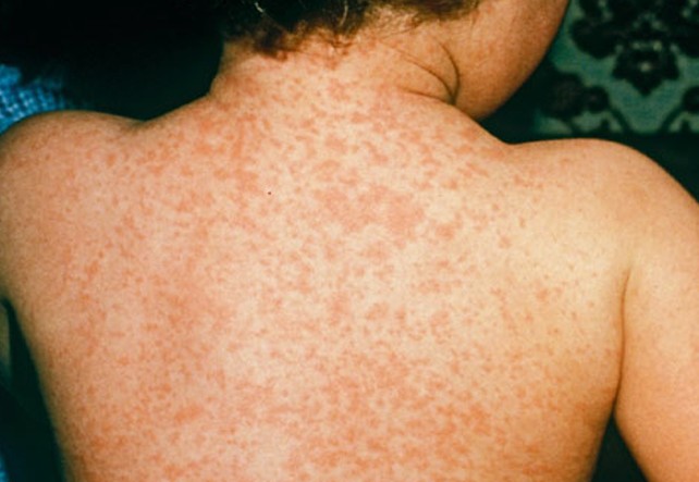 Meningococcal Meningitis Rash Pictures Photos