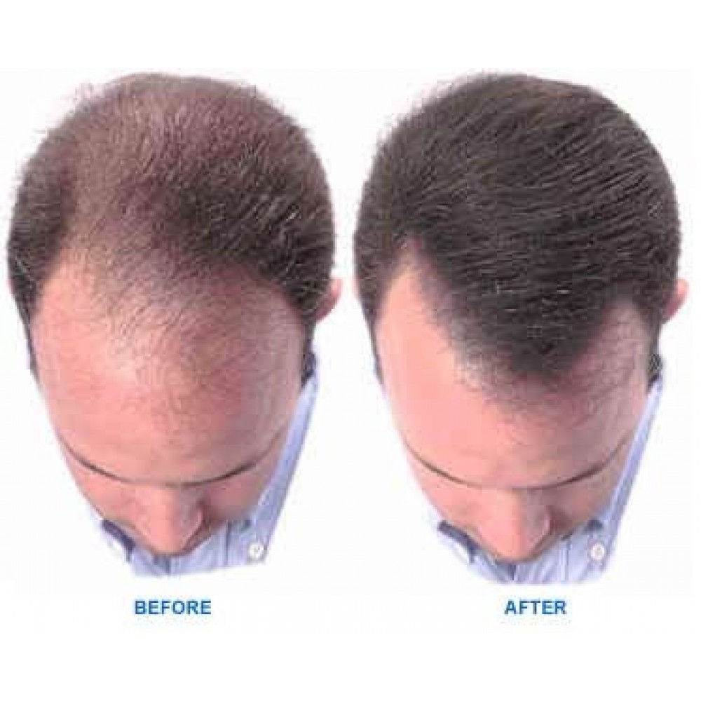 minoxidil - pictures, photos