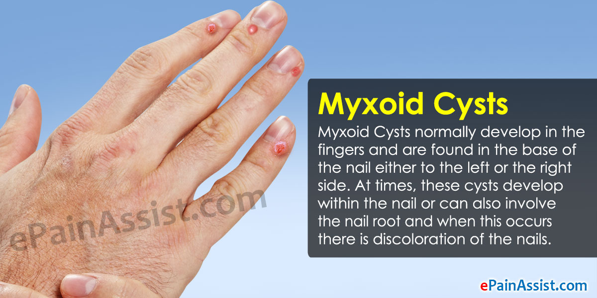 myxoid-cyst-treatment-pictures-photos