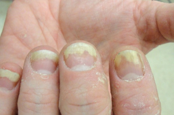 fingernail-conditions-pictures-photos