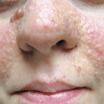 Hot Tub Rash  Pseudomonas Folliculitis - Skinsight