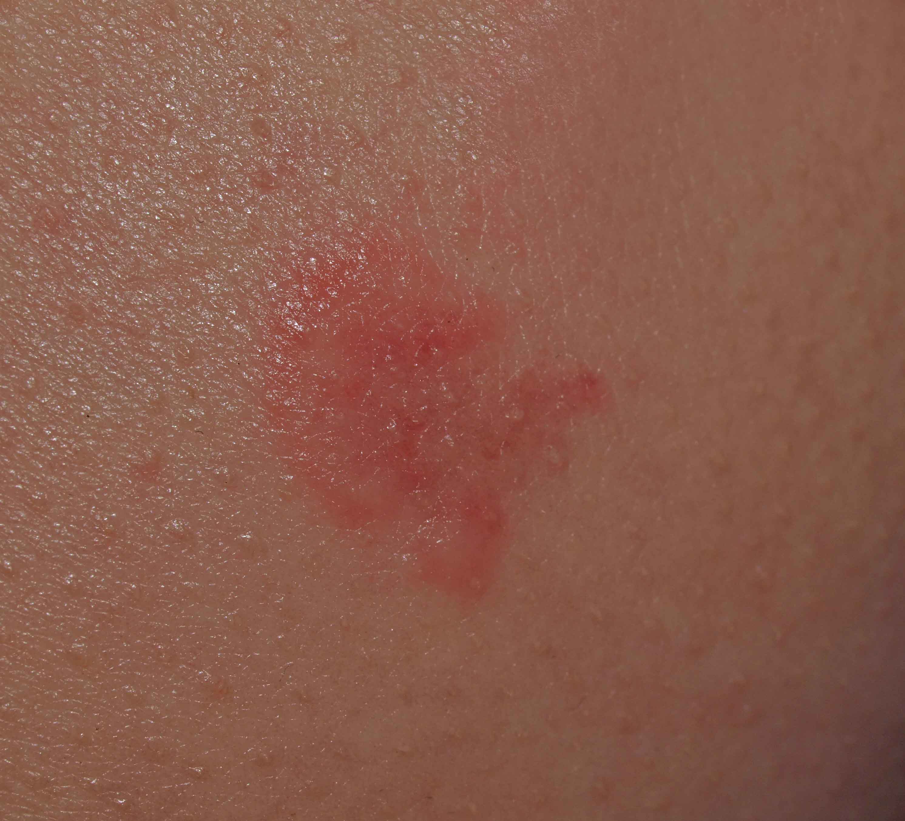 blister-like-bumps-on-skin