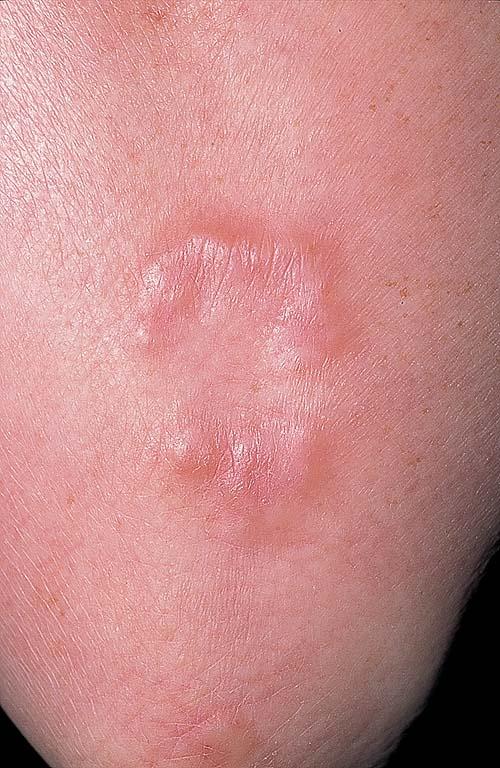 granuloma annulare elbow - pictures, photos