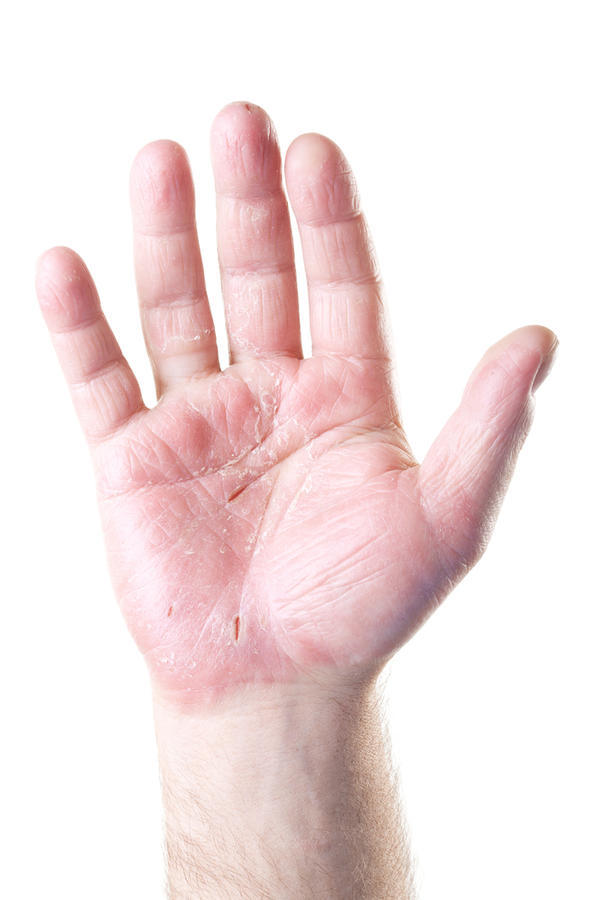itching palms and feet pictures, photos