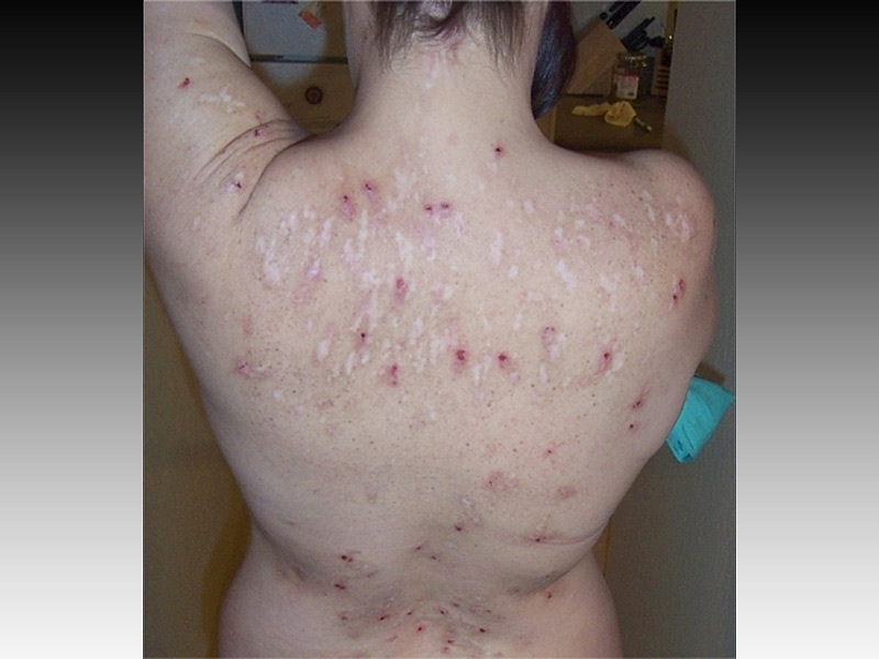 morgellons disease treatment - pictures, photos