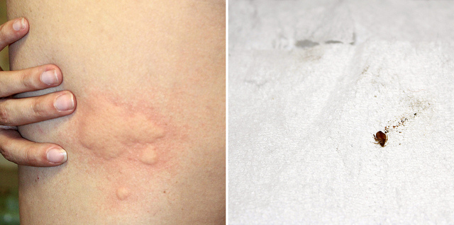 Outcomes Of Bed Bug Bite 