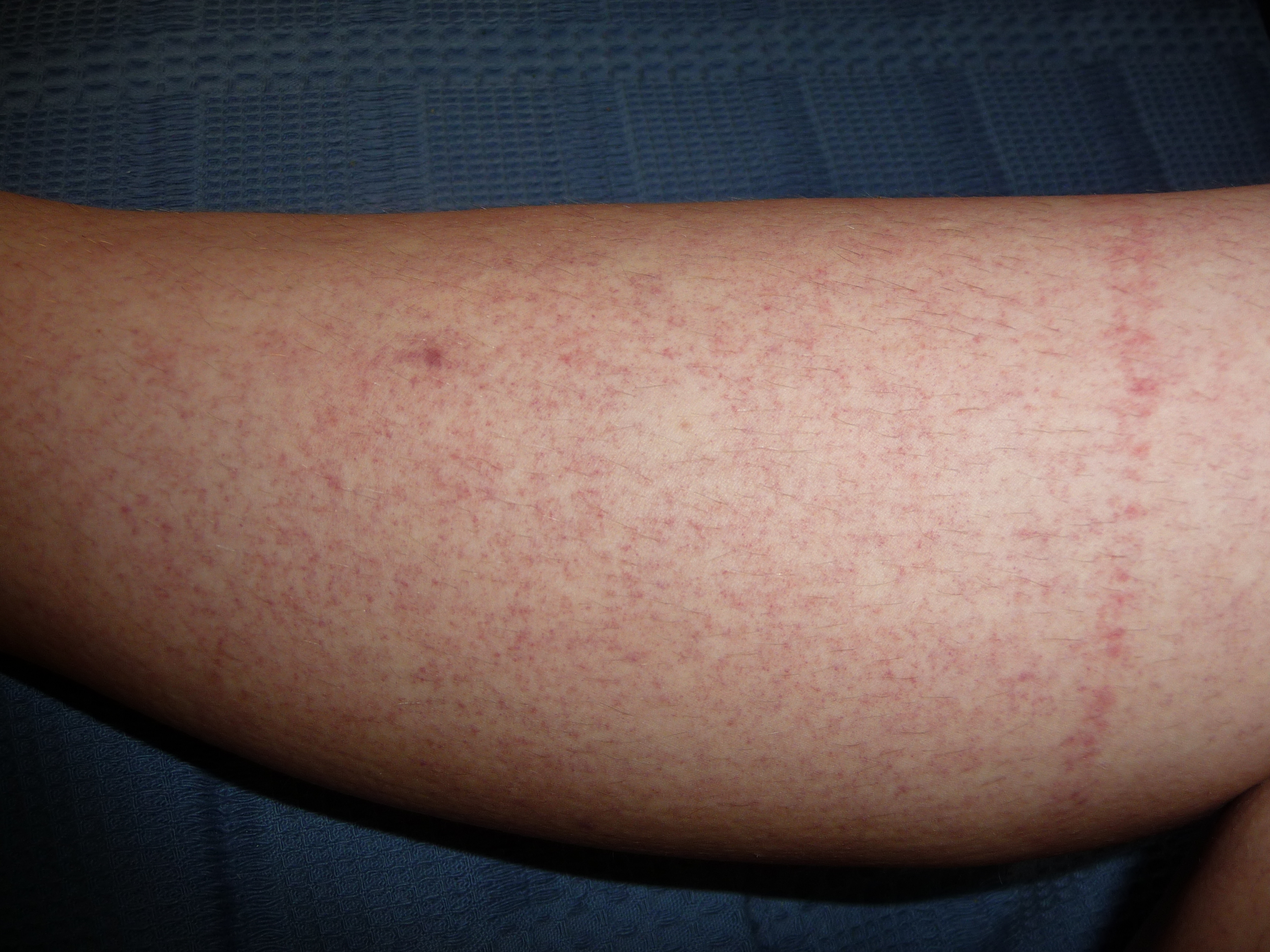 Sudden Rash On Legs Pictures Photos