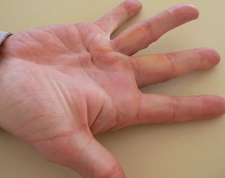 palmar-erythema-causes-pictures-photos