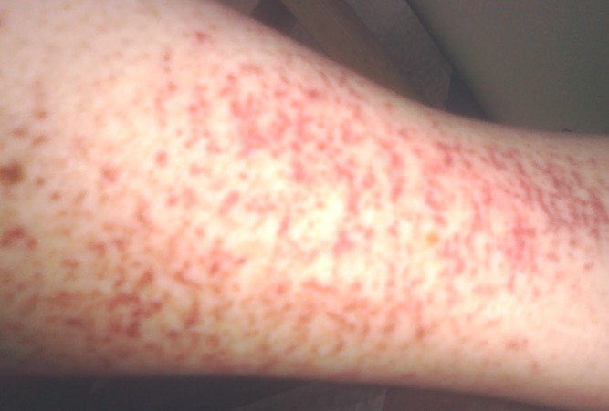 pinpoint rash with itching