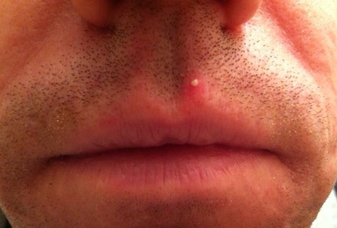 lip cyst herpes