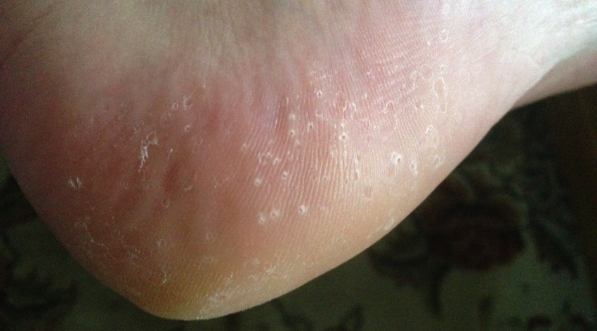 pimples-on-bottom-of-feet-pictures-photos