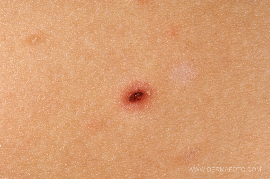 pityriasis-lichenoides-pictures-photos