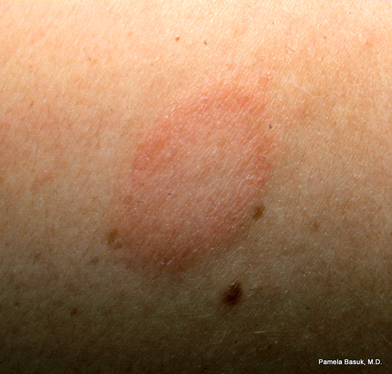 Herald Patch Rash Pictures Photos