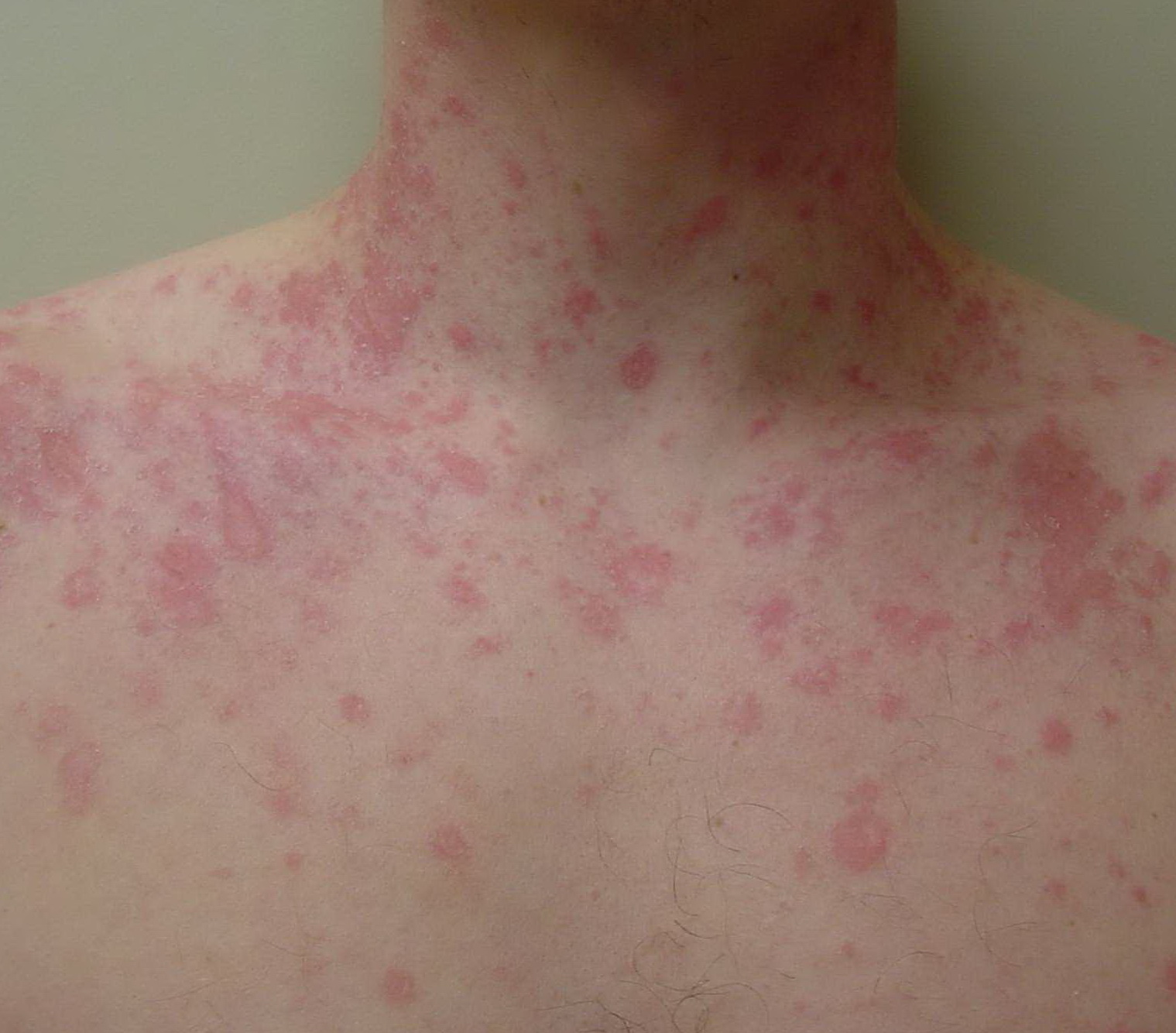 Pictures Of Pityriasis Rosea Pictures Photos