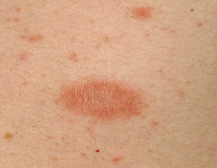 what is pityriasis rosea - pictures, photos