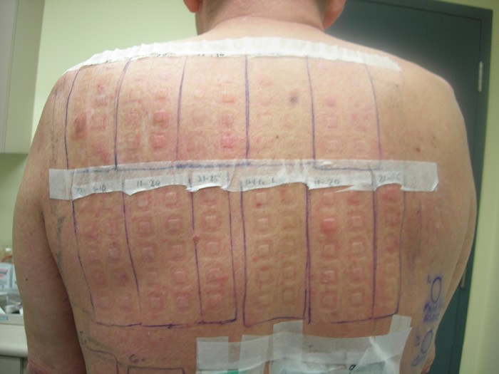 patch-test-for-allergies-pictures-photos