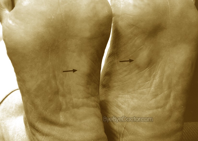 what is fibromatosis - pictures, photos