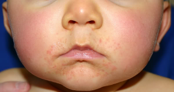 rash in children - pictures, photos