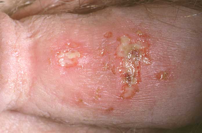 herpes-simplex-virus-type-2-pictures-pictures-photos