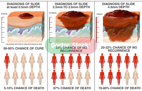 What Is Metastasis Melanoma Pictures Photos What Is Metastasis Melanoma Pictures Photos