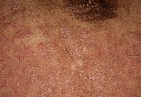 icd 10 code for pruritic urticarial papules and plaques of pregnancy
