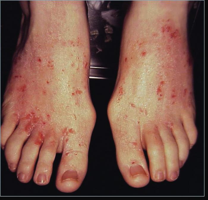 pruritus-symptoms-pictures-photos