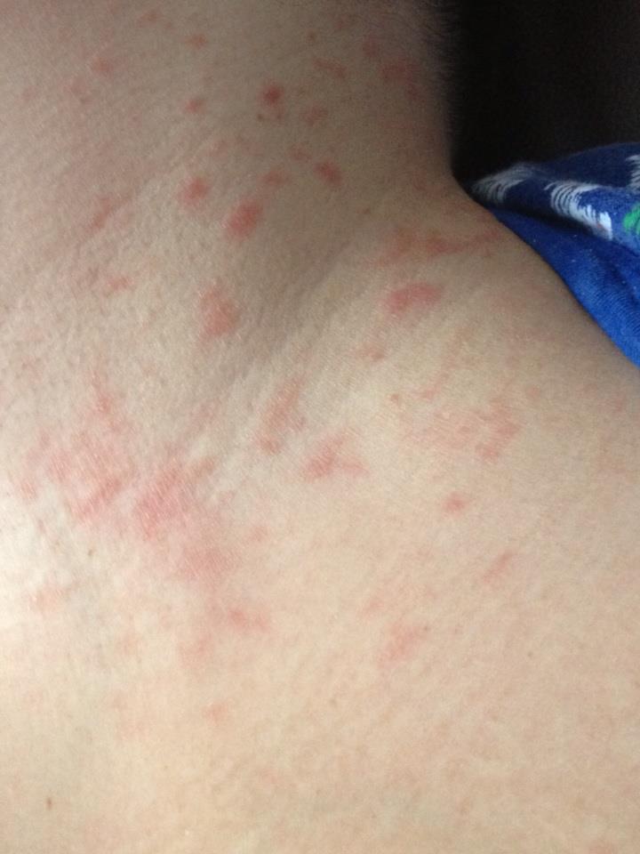  rash  on neck and back pictures photos