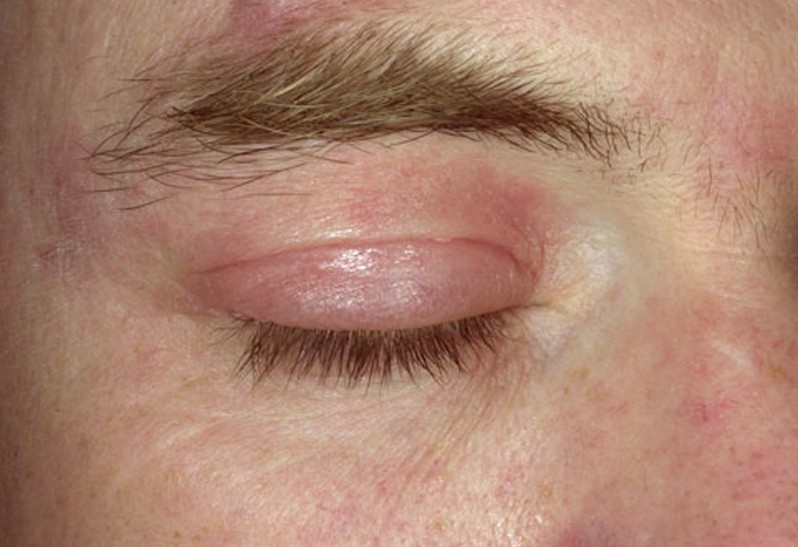 What Can I Put On A Rash Around My Eyes