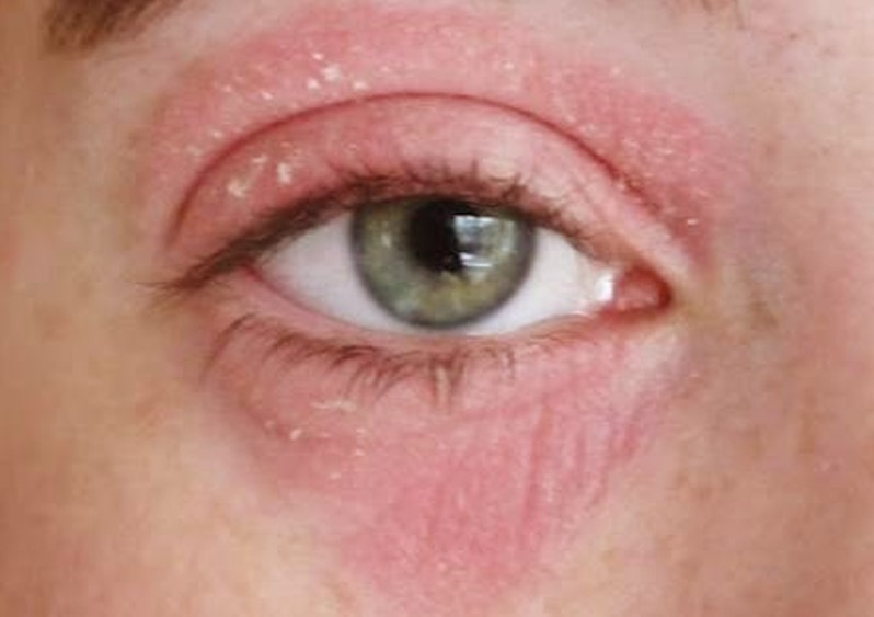 Skin Rashes Around Eye Pictures Photos