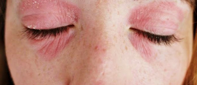 rashes under eyes - pictures, photos