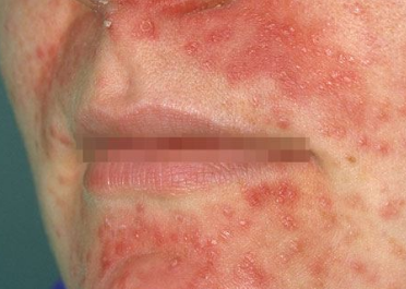 rashes under nose - pictures, photos