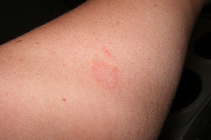 Herpes Rash On Arm Shingles Zoster Or Herpes Zoster Symptoms On Arm